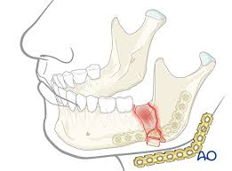 Full Mouth X-Ray (OPG) - Accurate Dental Diagnosis